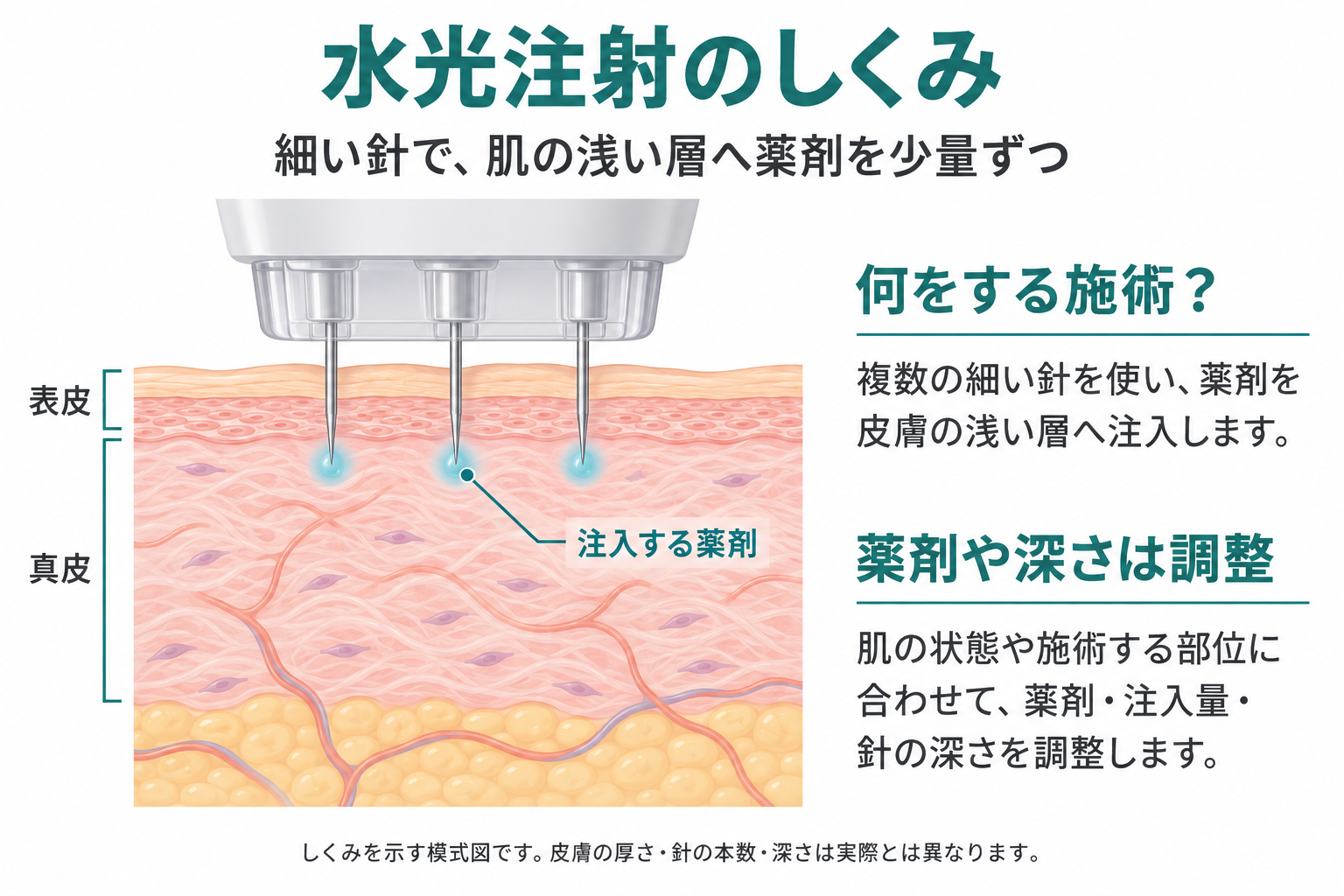 水光注射のしくみ。表皮を通して真皮の浅い層へ薬剤を少量ずつ注入する模式図。肌の状態や部位に合わせて薬剤・注入量・針の深さを調整します。